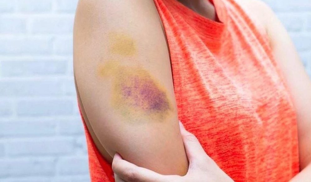 Ушибы, растяжения, гематомы — как ускорить заживление без осложнений